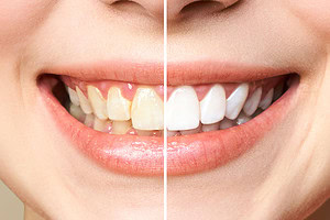 Zahnarzt Dr. Nekzai Hamburg - Veneers, bleaching